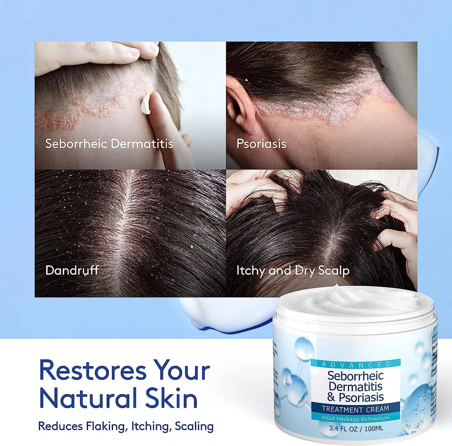 Seborrheic Dermatitis & Psoriasis Relief Cream